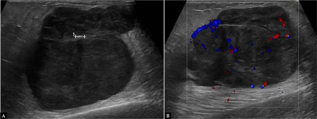 Hematoma ecografia tempo formacion 6.jpg